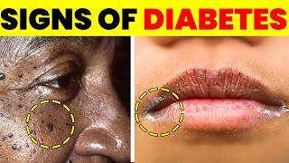 21 Shocking Signs You Have Diabetes—Even If You Have No Idea [upl. by Enelahs]