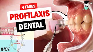 PROFILAXIS DENTAL 4 fases ¿Cómo llenar el Indice IHOS [upl. by Virgina955]