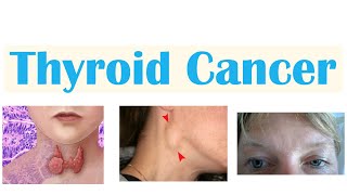 Thyroid Neoplasms Pathology  Follicular  Papillary  Anaplastic  Medullary Carcinoma  MedLive [upl. by Effy]