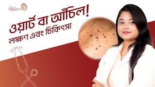 Wart । Dr Zakia Tasnim  Dhaka Dermatology Institute [upl. by Ardnuassak]