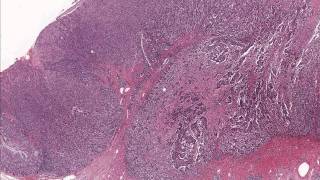 Colon Adenocarcinoma  Microscopic Diagnosis and Molecular Testing [upl. by Billie]