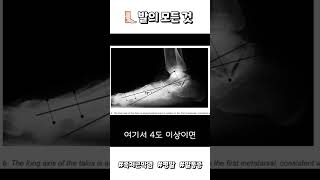 군대 평발 면제 기준 feat 신체검사 신검 [upl. by Charleen]