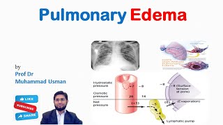 Pulmonary Edema  Pulmonary Interstitial Fluid formation  Safety Factor  Physiology of Respiration [upl. by Ecnatsnok]