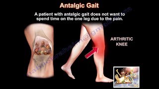 Painful Gait Antalgic Gait  Everything You Need To Know  Dr Nabil Ebraheim [upl. by Anivid]