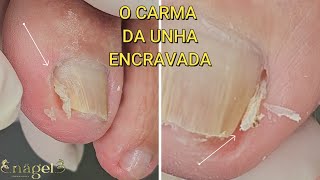 😥VOCÊ ACREDITA QUE ELA VIVE COM TUDO ISSO ALI SEMPRE satisfying ingrowntoenail [upl. by Elyrrad422]