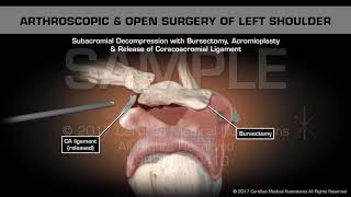 Arthroscopic amp Open Surgery of Left Shoulder [upl. by Erret183]