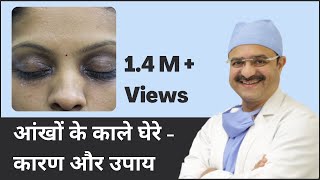 आंखों के काले घेरे  कारण और उपाय Under Eye Dark Circles Causes amp Treatments  In HINDI [upl. by Yeknarf]