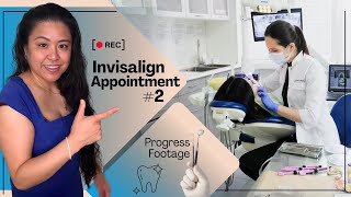 Invisalign Journey Appointment 2 MUST SEE [upl. by Airahcaz]