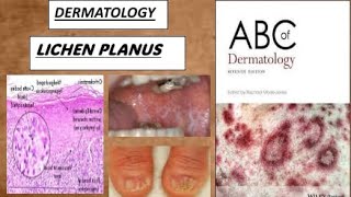 DERMATOLOGY LICHEN PLANUS derma lichenplanus [upl. by Htiekal168]