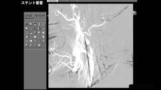 頸動脈ステント留置術 [upl. by Nhabois]