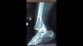 Girl skating and dislocated her ankle [upl. by Ashjian]