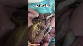 Gastroschisis  Giant Gastroschisis in neonate neonates neonatology [upl. by Verney]