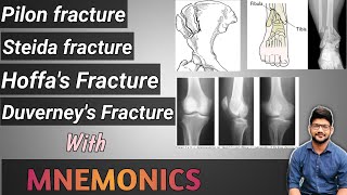 Dr Tricks Bone Fracture Series 6  Steida fracture  Hoffas  Duverneys  Pilon  With MNEMONICS🔥 [upl. by Novek]