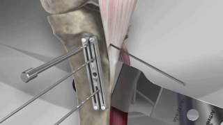 Tibial Tubercle Osteotomy [upl. by Leind]