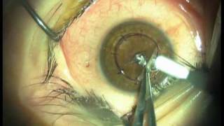 Deep Anterior Lamellar Keratoplasty DALK modified big bubble [upl. by Starlene575]