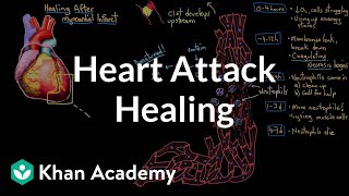 Healing after a heart attack myocardial infarction  NCLEXRN  Khan Academy [upl. by Vala305]