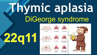 Thymic aplasia  DiGeorge Syndrome  USMLE Step 1 Immunology [upl. by Einatsed]