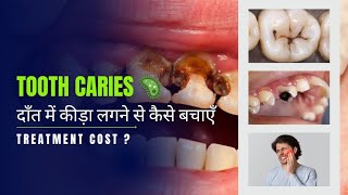 दांतों के कीड़े का इलाज  How to Stop Tooth Decay  Epsiode1 [upl. by Liek]