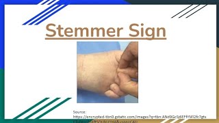 Stemmers Sign in Lymphedema A Key Diagnostic Indicator Explained [upl. by Einnov522]