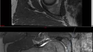 Hip MRI Approach to MSK MRI Series [upl. by Eux]