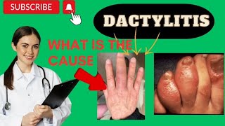 Dactylitis or sausage finger [upl. by Ennayk]