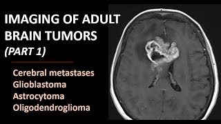 Imaging of brain tumors part 1 metastases glioblastoma and beyond [upl. by Ecertak846]