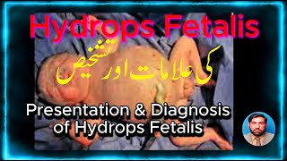 Presentation and Diagnosis of Hydrops Fetalis کی علامات اور تشخیص Hydrops Fetalis [upl. by Asyal552]