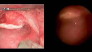 Dual Endoscopy Demo [upl. by Adriano]