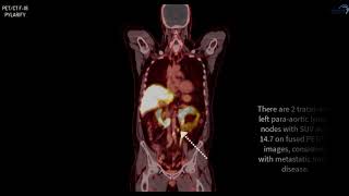 PSMA PET CT F18 Pylarify Case 3 [upl. by Tekcirc407]