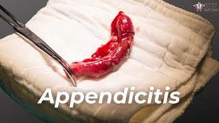 What Causes Appendicitis amp How to Treat It [upl. by Clauddetta]