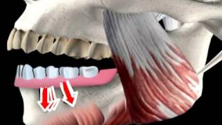 what is a hybrid prosthesis  hybrid dentures [upl. by Prouty]