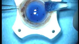 DALK with big bubble technique in keratoconus [upl. by Ellerahc]