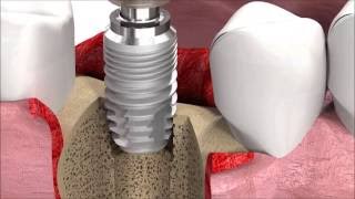 SIC invent Dental Implant Procedure SICmax implant insertion [upl. by Alesram]