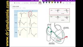 LBBB and RBBB left VS right bundle branch block Dr Jamal USMLE  Cardiology ECG lecture [upl. by Eznyl]