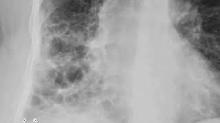 Chest X ray in Bronchiectasis Findings radiology cxr [upl. by Qiratla241]