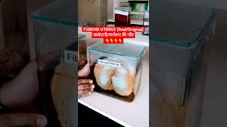 Fibroid uterus  बच्चेदानी की गाँठ । Uterine myoma [upl. by Eylloh]