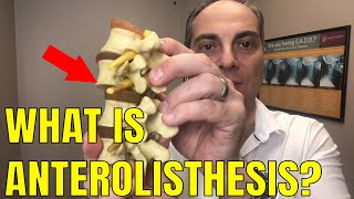 Ep61 What Does Anterolisthesis Of L5 Mean  Dr Walter Salubro Chiropractor in Vaughan [upl. by Suirad]