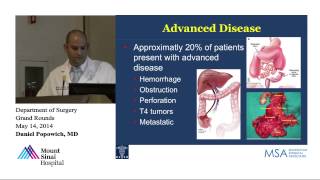 Updates on Colorectal Cancer [upl. by Adikram]