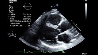 Routine Echocardiogram Protocol With Standard 2D Echo Images and Color Doppler [upl. by Shelba]