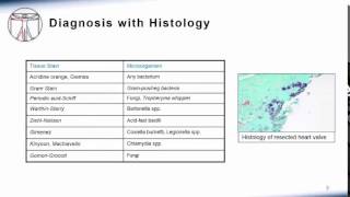 Endocarditis Culture Negative Endocarditis [upl. by Yeta]