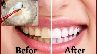 DIY Teeth Whitening at Home in 2 minutes [upl. by Calisa]