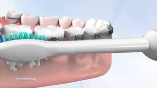 Tips on how use a Philips Sonicare toothbrush with braces Hygiene is a key part of daily care [upl. by Reiners747]