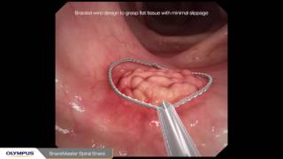 Endoscopic Mycosal Resection EMR procedure overview of a sessile polyp using Olympus devices [upl. by Andromede]