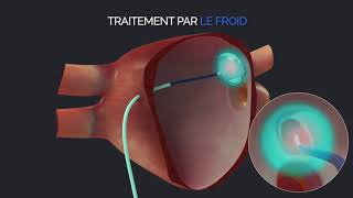 MEDUVIP  Teaser Vidéos Médicales Pédagogiques  Ablation de FA [upl. by Anrat257]