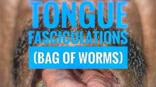 Tongue fasciculations quotBag of wormsquot  mbbs medicine neurology [upl. by Telocin]