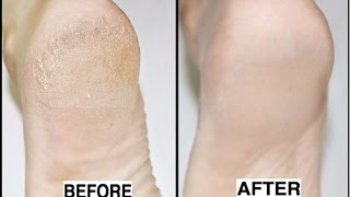 How to Get Rid of Cracked Heels in Just 3 Nights [upl. by Rayham]