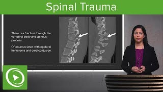 Spinal Trauma Cervical Trauma Protocol Common Spinal Fractures – Radiology  Lecturio [upl. by Ellebanna265]