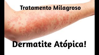 Tratamento para Dermatite Atópica [upl. by Abehshtab]