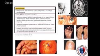 ENDOCARDITIS INFECCIOSA [upl. by Maloney397]