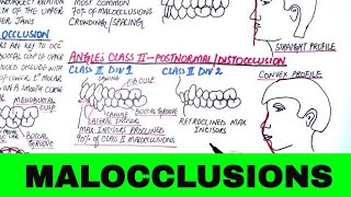 Angles Classification of Malocclusion  Orthodontics [upl. by Kiernan848]